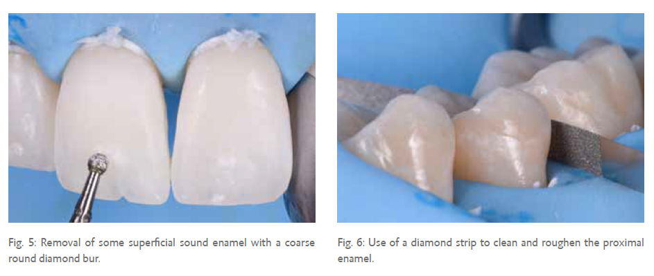 Fig. 5: Removal of some superficial sound enamel with a coarse round diamond bur. Fig. 6: Use of a diamond strip to clean and roughen the proximal enamel.